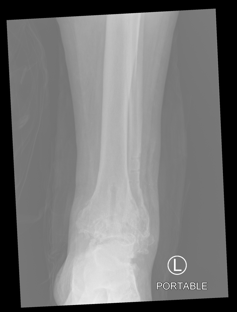 Ankle xray, post fusion with hardware removed