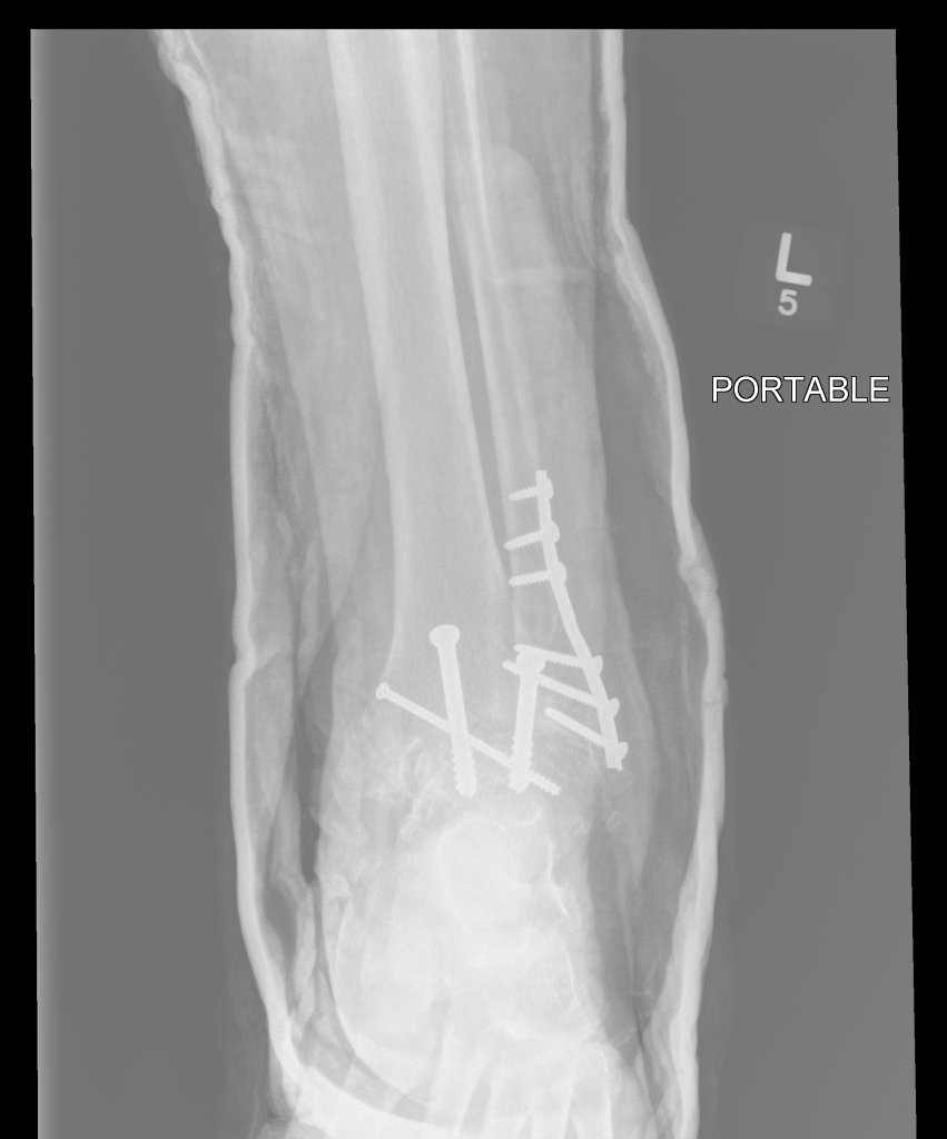 Post-operation ankle x-ray with a variety of surgical screws and hardware